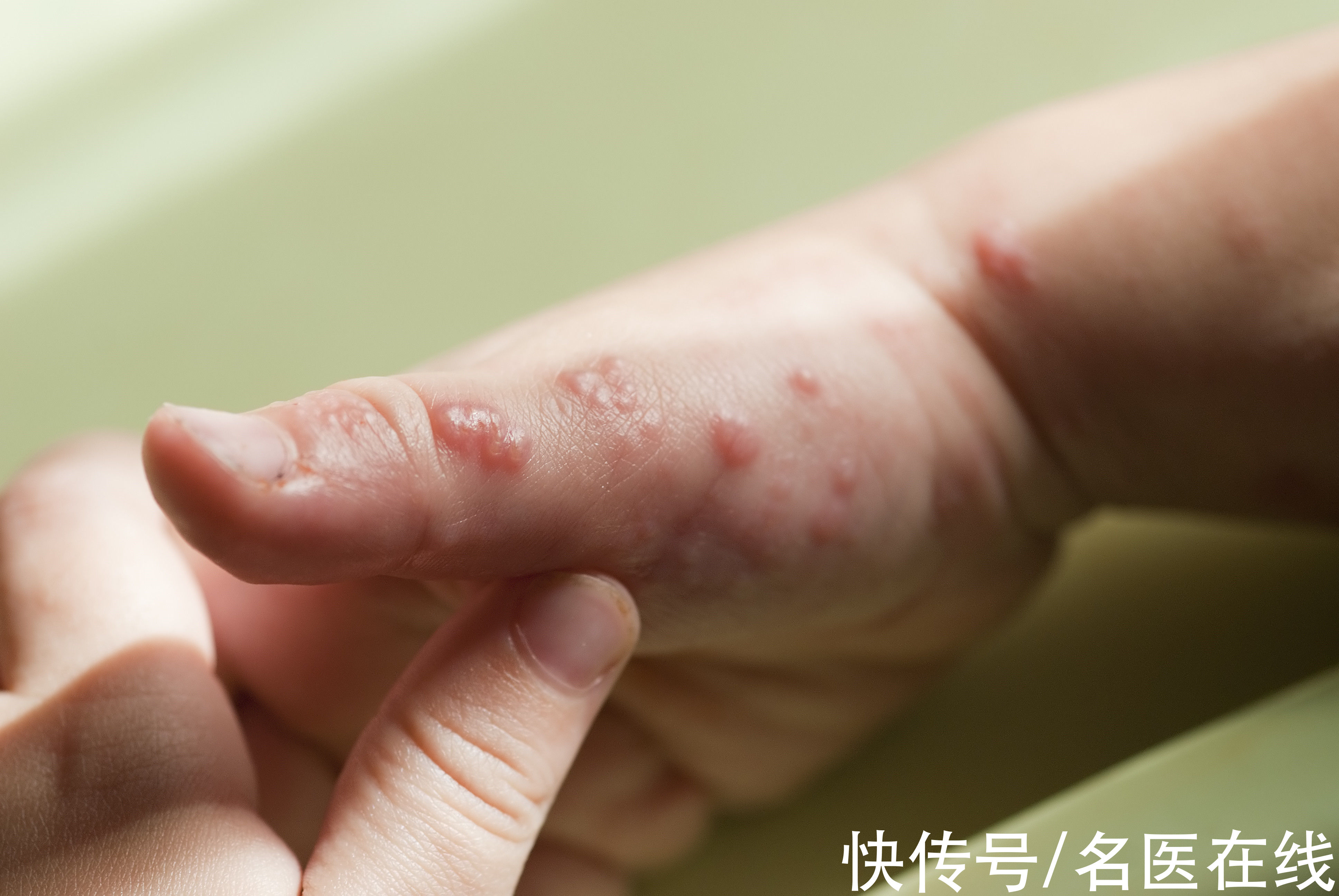 带状疱疹有时会被误认是皮炎